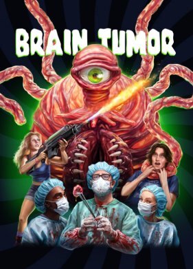 Опухоль мозга